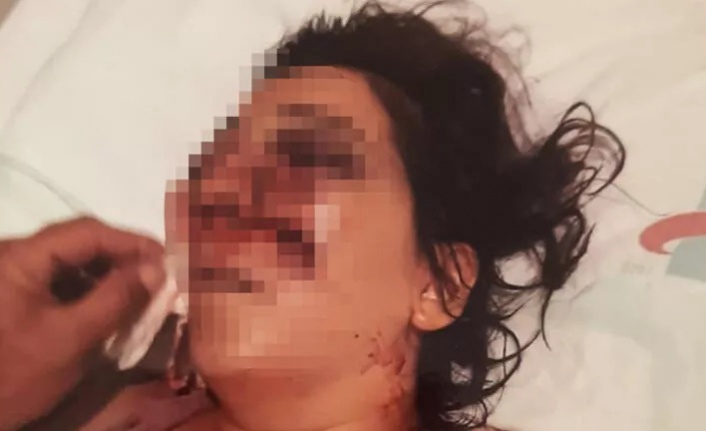 Gittiği tatilde dehşeti yaşadı! Altı ameliyat geçirdi ama gözünü kaybetti