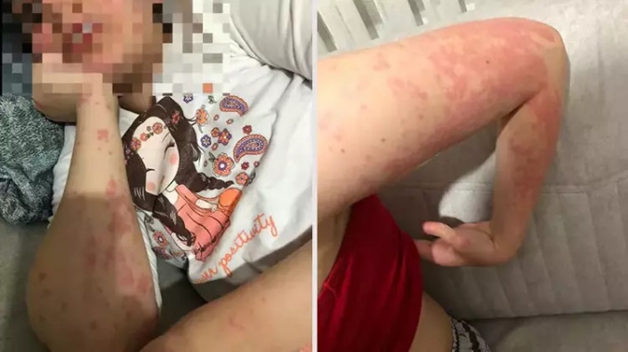 Eczacının otizmli Zeynep'e verdiği muadil ilaç alerjik etki yaptı; baba şikayetçi oldu