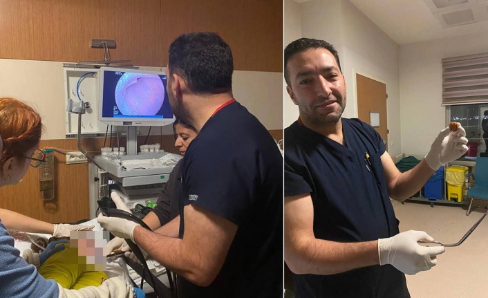 Zihinsel engelli kadının yemek borusuna kaçan ceviz, operasyonla çıkarıldı